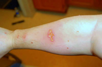 Burned skin from laser pointer