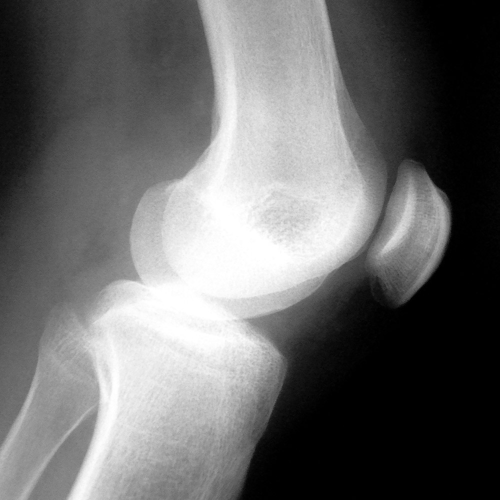 An x-ray of a human knee.
