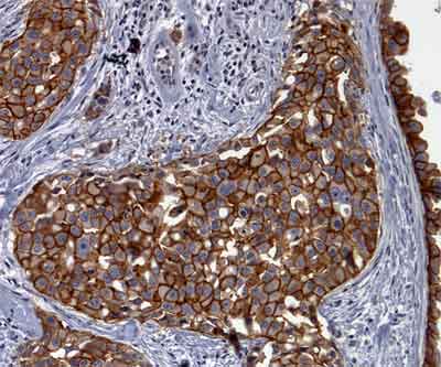 Picture of Her-2 immunostaining of human breast cancer tissue